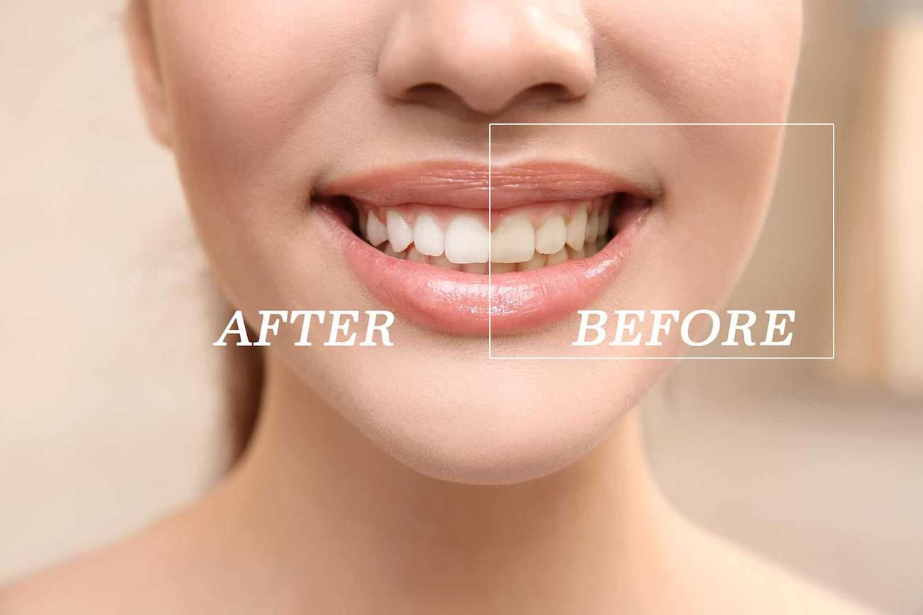 What Are the Most Effective Natural Teeth Whitening Methods You Can Try St Helens?