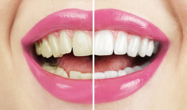 What Makes Ultima White Teeth Whitening Different St Helens