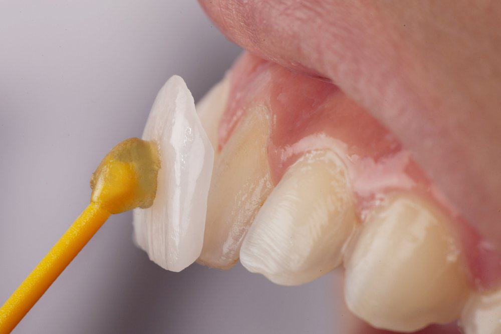 Why Do Dental Crowns Fail or Get Damaged Prematurely St Helens?
