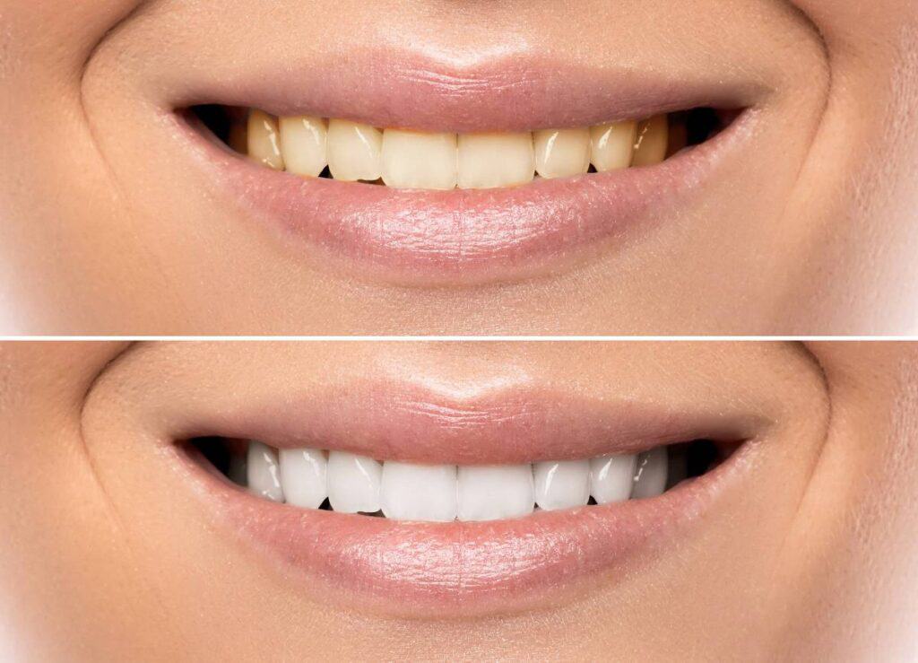 How Can You Protect Your White Smile as a Coffee Lover St Helens?