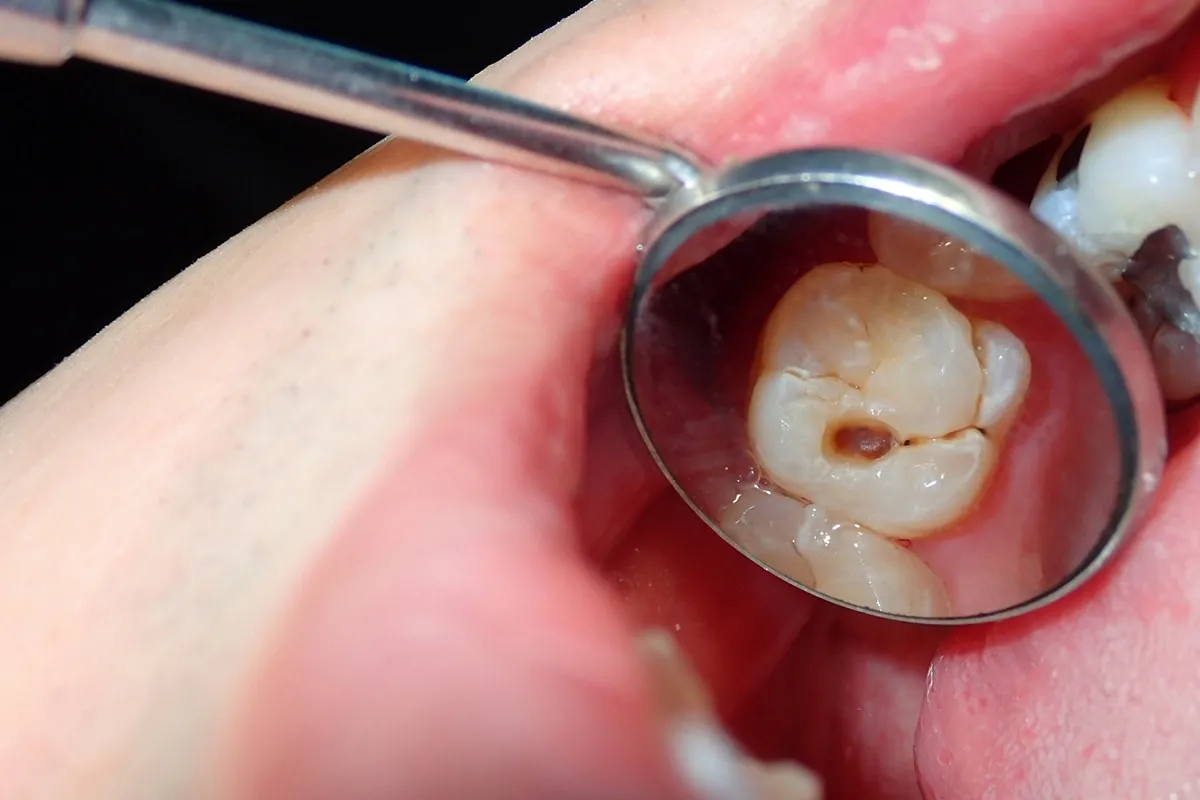 Why Do Teeth Crack? Common Causes to Know St Helens