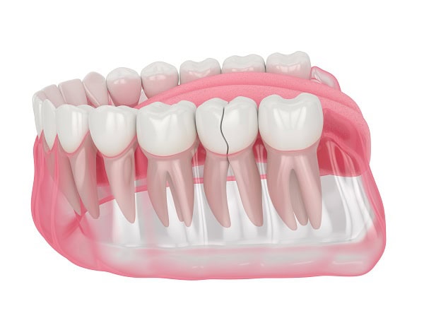 How Can You Manage Pain and Discomfort After a Root Canal St Helens?