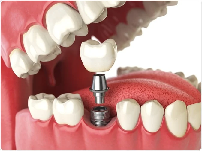 How Do I Decide Which Tooth Replacement Is Right for Me St Helens?