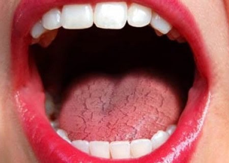 Common Causes of Dry Mouth (Xerostomia) St Helens