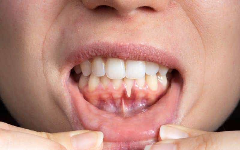 How Can Gum Disease Be Prevented St Helens?