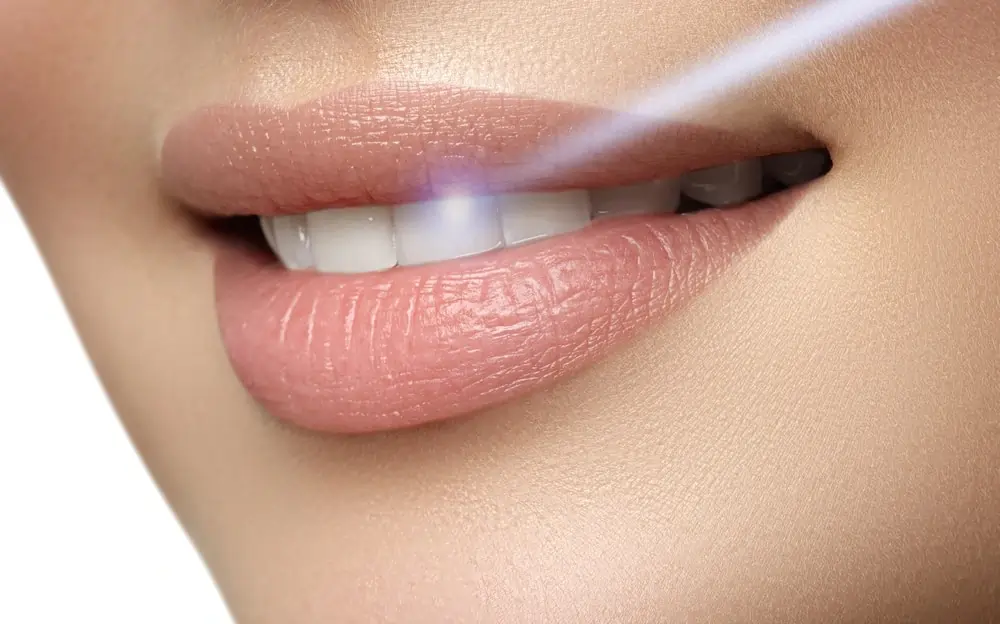 A Smarter Alternative: At-Home Laser Teeth Whitening St Helens