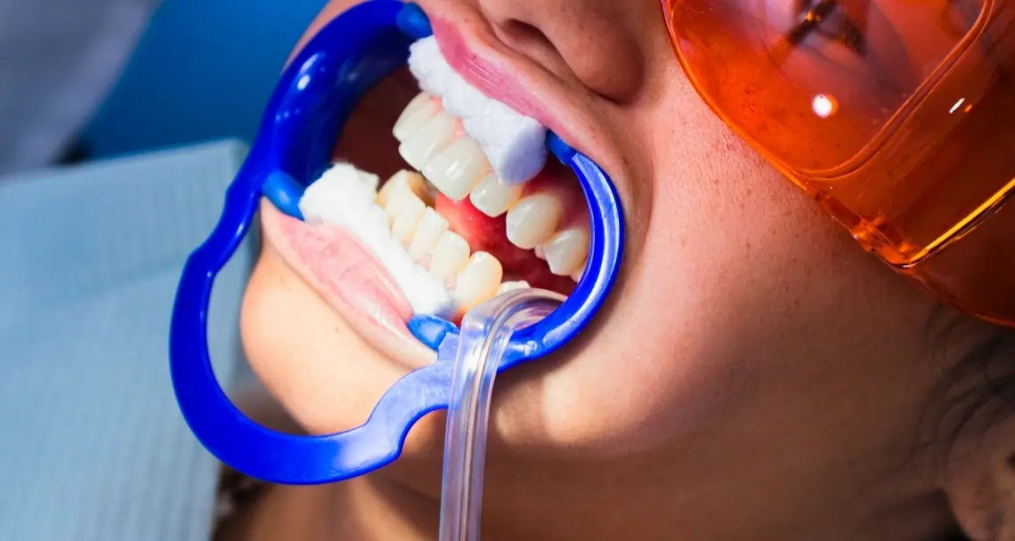 How Can You Prevent the Need for a Root Canal in the Future St Helens?