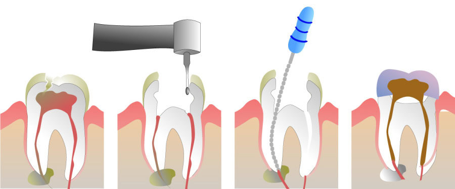 How Do You Properly Care for Your Teeth After a Root Canal St Helens