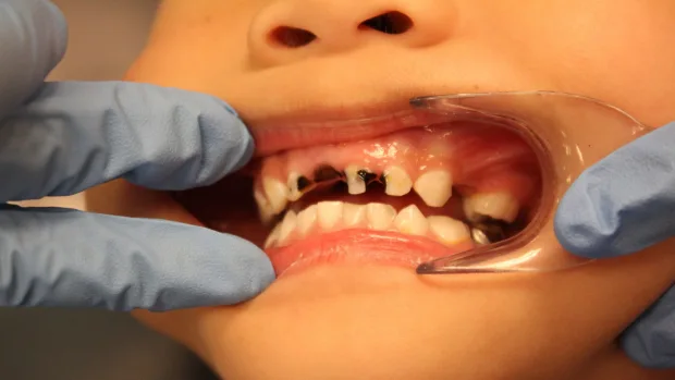 Can Your Diet Help You Achieve a Whiter, Healthier Smile St Helens?