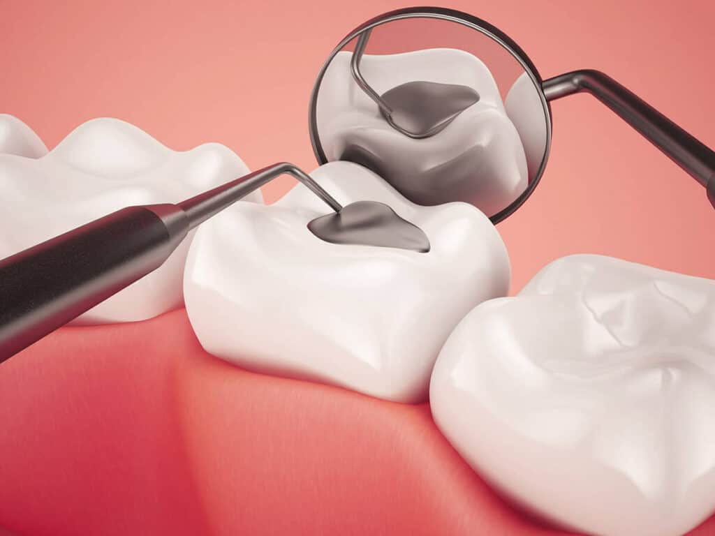 How Can You Prevent Tooth Decay Effectively St Helens