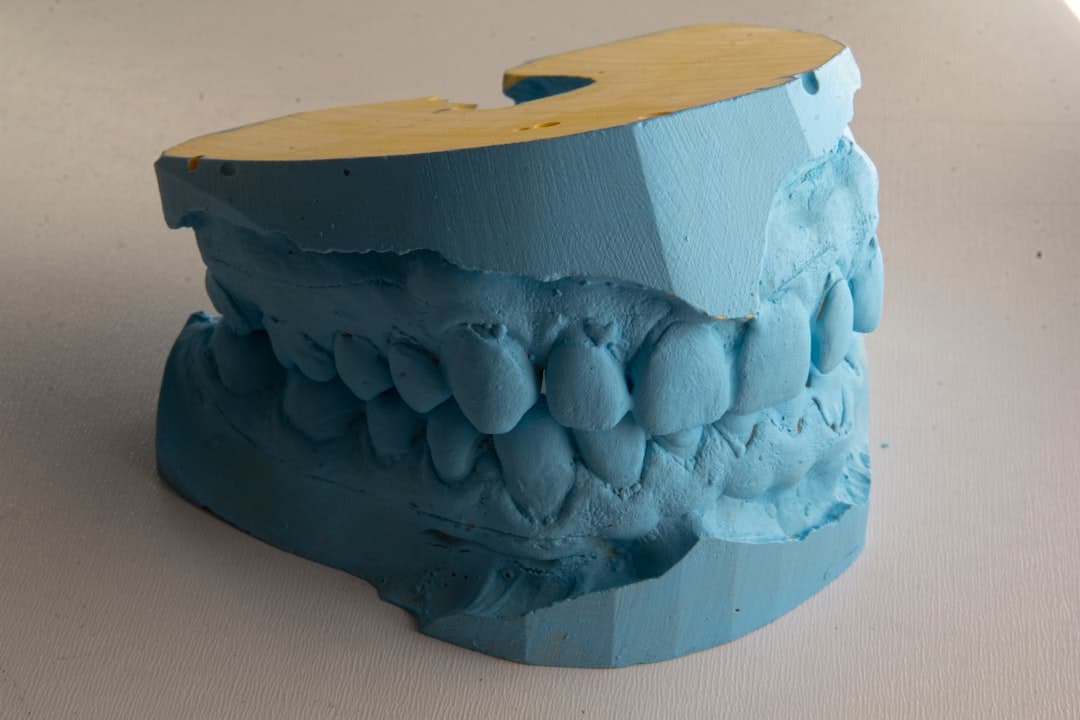 How Do Dental Implants Improve Jawbone Health and Oral Function St Helens?
