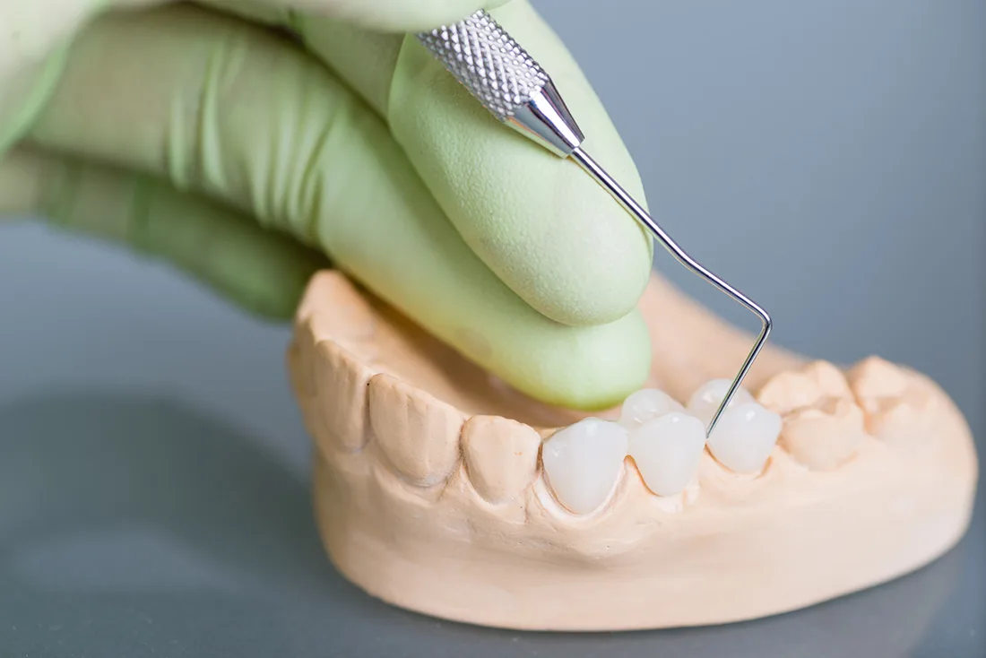 Do Braces Take Years to Show Results St Helens