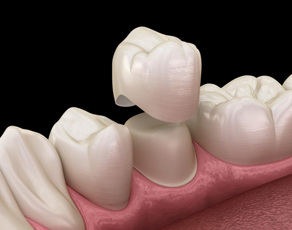How Can You Prevent Common Dental Crown Problems St Helens?