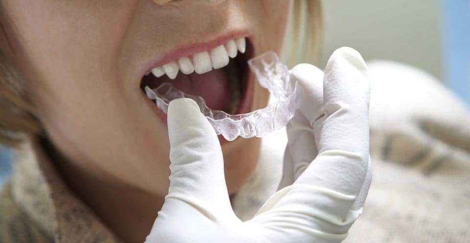 How Much Does Laser Teeth Whitening Cost Compared to Overnight Trays St Helens?