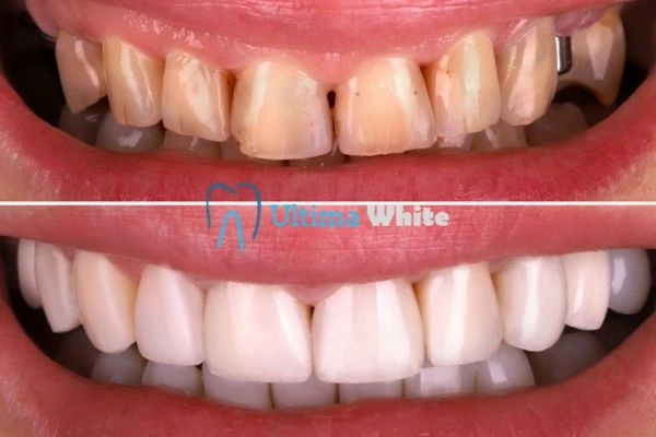 What Makes Instant Teeth Whitening Treatments So Popular St Helens?