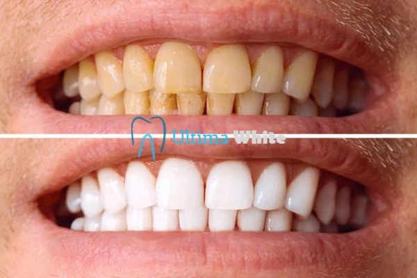 Stained Teeth and Persistent Bad Breath St Helens