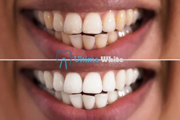 Aftercare Tips to Maintain Your New Smile St Helens